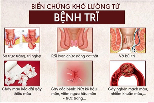 Chi phí chữa bệnh trĩ